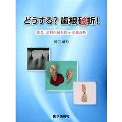 どうする?歯根破折!－患者、歯科医師を救う迅速診断 [単行本]