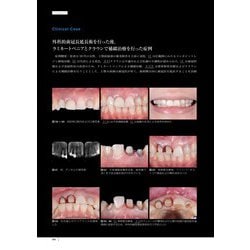 裁断済」The Tooth Preparation : 補綴修復治療の成功・・ - www