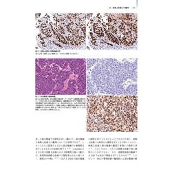 前立腺癌第2版　腫瘍病理鑑別診断アトラス 81N26QsWOrL._UF1000,1000_QL80_.jpg