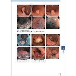 裁断済　美しい画像で見る内視鏡アトラス 上部消化管　下部消化管 美しい画像で見る内視鏡アトラス 下部消化管〜腫瘍から感染性