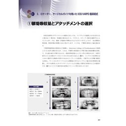ヨドバシ.com - パーシャルデンチャーの基本を押さえたIOD